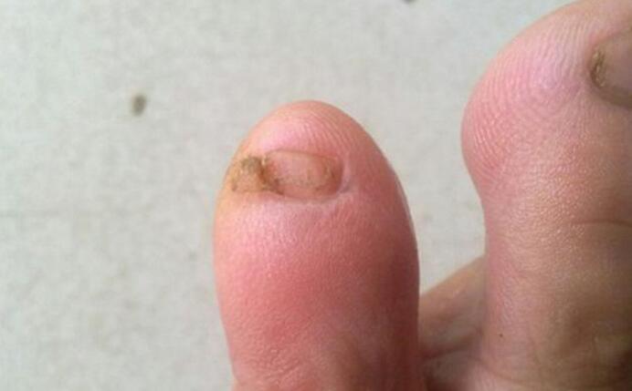 小脚趾头指甲分两瓣,如果你的小脚趾有两瓣趾甲