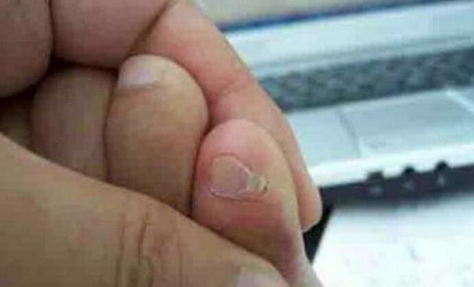 小脚趾头指甲分两瓣,如果你的小脚趾有两瓣趾甲