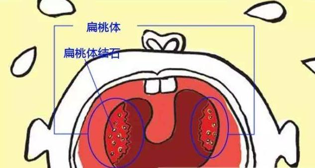从小到大口臭的厉害,从小到大口臭特别重