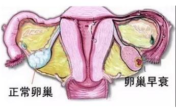 卵巢功能衰退会导致什么后果,卵巢功能为什么会衰退