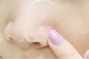 痘痘留下的坑印怎么办,脸上痘痘擦什么药膏不留印