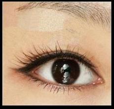 近视矫正激光手术的利与弊,激光矫正近视需理智