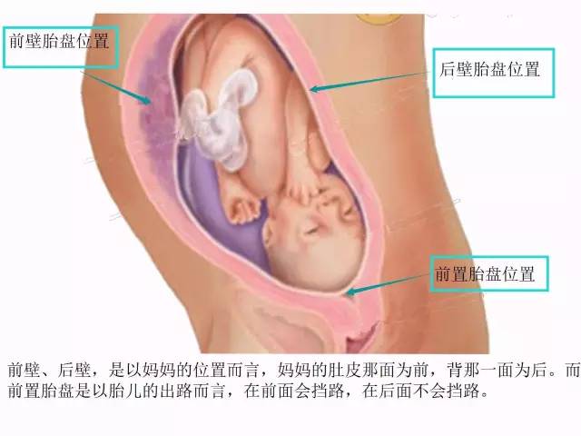 “胎盘低置状态”是个什么状态？