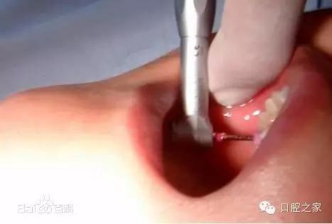 根尖脓肿反反复复治疗方法,牙根尖炎反反复复会不会癌变