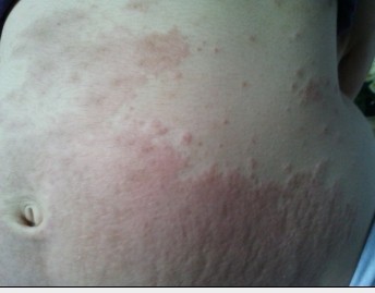 产后瘙痒症会自然好吗,产后下阴瘙痒可以用什么药