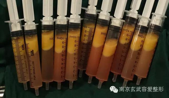 自体脂肪丰额头恢复期图,自体脂肪丰额头第一天图片