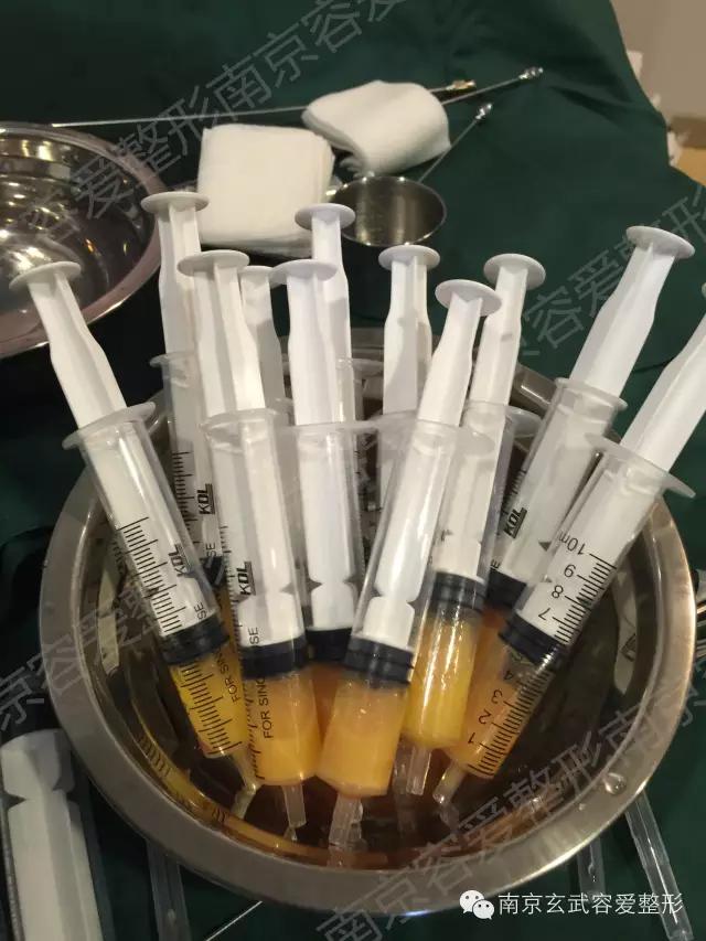 自体脂肪丰额头恢复期图,自体脂肪丰额头第一天图片