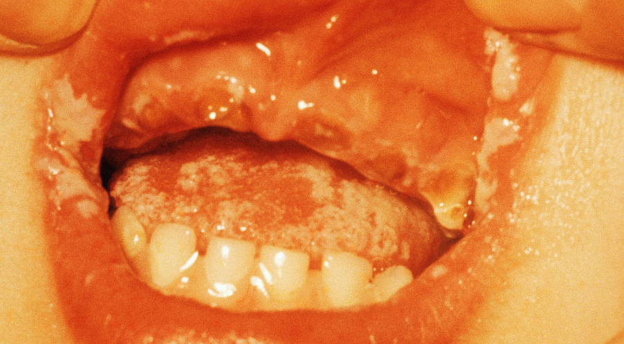 一个不能忽略的感染，皮肤真菌感染的药物治疗