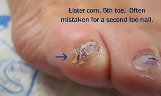 小脚趾头指甲分两瓣,如果你的小脚趾有两瓣趾甲