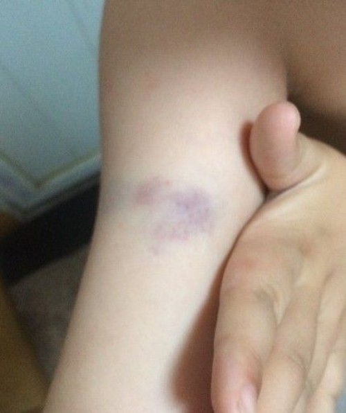 皮肤出现紫青色淤青,皮肤老是青一块紫一块看什么科