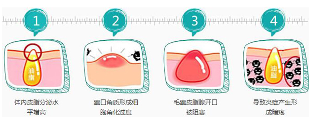 什么原因导致脸上长痘怎么办,四十岁脸上长痘啥原因