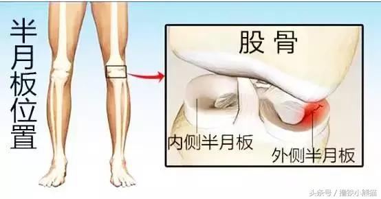 全方位解析,美国专业医生告诉你:膝关节损伤如何识别及自我治疗