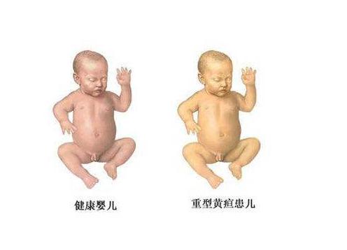宝宝有黄疸怎么办用什么方法,宝宝有黄疸应该怎样治疗