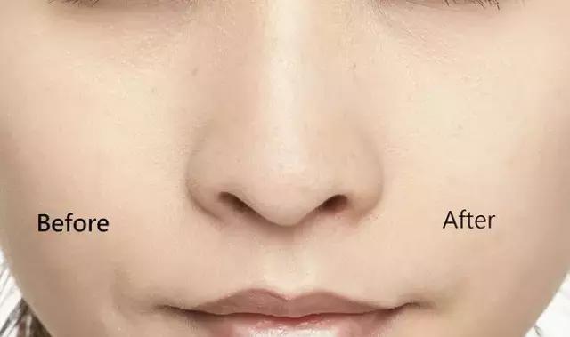 皮肤毛孔出油厉害怎么解决,皮肤出油毛孔大