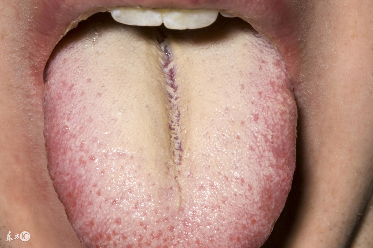 舌苔是厚厚的白苔用“姜”治口臭;舌苔发黄喝“萝卜汁”治口臭