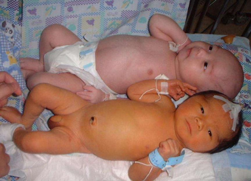 宝宝有黄疸怎么办用什么方法,宝宝有黄疸应该怎样治疗