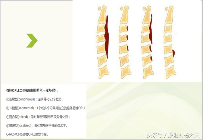神经根型颈椎病能按摩引起腿麻吗,颈椎x片能确诊颈椎病吗