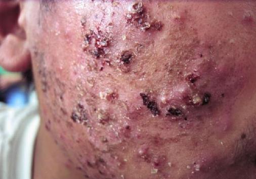 脸上起死皮还痒长疙瘩怎么回事,脸上长红疮起皮