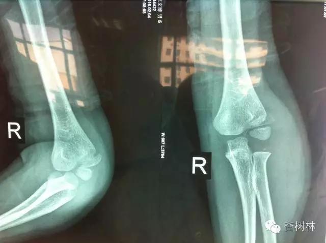 6岁孩子骨折手术怎么止疼,5岁儿童骨折怎么恢复