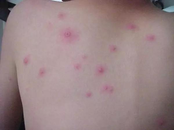 预防水痘发家长群温馨提示,水痘高发期幼儿园家长配合文案