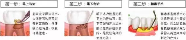 牙周病的治疗过程,牙周病的治疗全过程