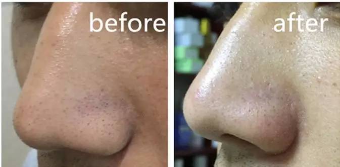 黑头难去怎么办,黑头怎么才能永远消失