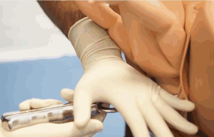 胎儿臀位出生视频,孕晚期胎儿臀位纠正视频