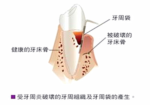 牙周治疗误区,牙周不好整牙