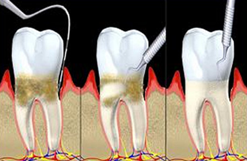 牙周治疗误区,牙周不好整牙