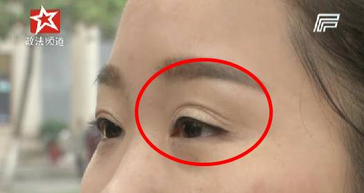 宁乡女子整容割成“三眼皮”，出门只能带墨镜！