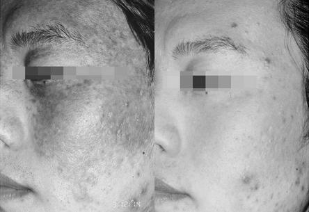 饮食助你除掉脸上黑斑,治脸上的黑斑点小妙招