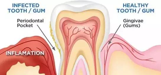 牙周病的治疗过程,牙周病的治疗全过程