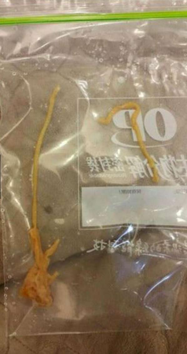 女孩吃过量泻药腹泻,女士吃泻药腹泻不止