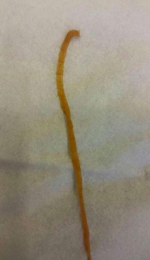 女孩吃过量泻药腹泻,女士吃泻药腹泻不止