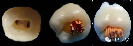 根尖脓肿反反复复治疗方法,牙根尖炎反反复复会不会癌变