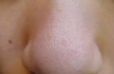 黑头难去怎么办,黑头怎么才能永远消失