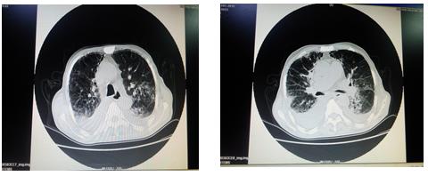 慢性心衰的护理病例讨论,发现有慢性心衰应如何处理治疗