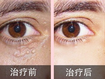 眼睛周围的汗管瘤激光多少钱,眼睛附近都是小汗管瘤有啥好方法