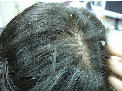 头皮屑满天飞吃什么能缓解,头皮屑像雪花满天飞