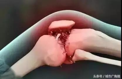 医院开的外敷药能治疗骨刺吗,膏药能彻底根治骨刺