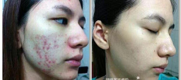 脸部痘坑修复小妙招,脸上有痘坑怎么治疗最好