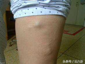 怀孕初期腿上青筋会跳明显吗,生完小孩小腿有条黑线是怎么回事