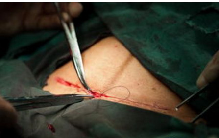 剖腹产横着开一刀还是竖着开一刀,剖腹产产房纪实