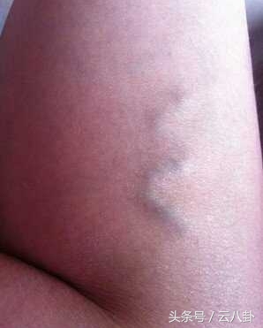 怀孕初期腿上青筋会跳明显吗,生完小孩小腿有条黑线是怎么回事