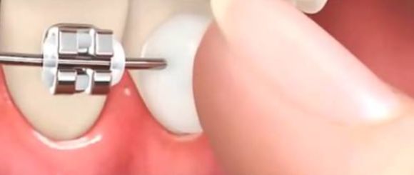 矫正牙齿后经常口腔溃疡怎么办,牙齿矫正口腔溃疡最快解决方法