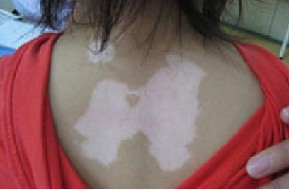 白癜风治好的真实案例,真实有效治白癜风中医