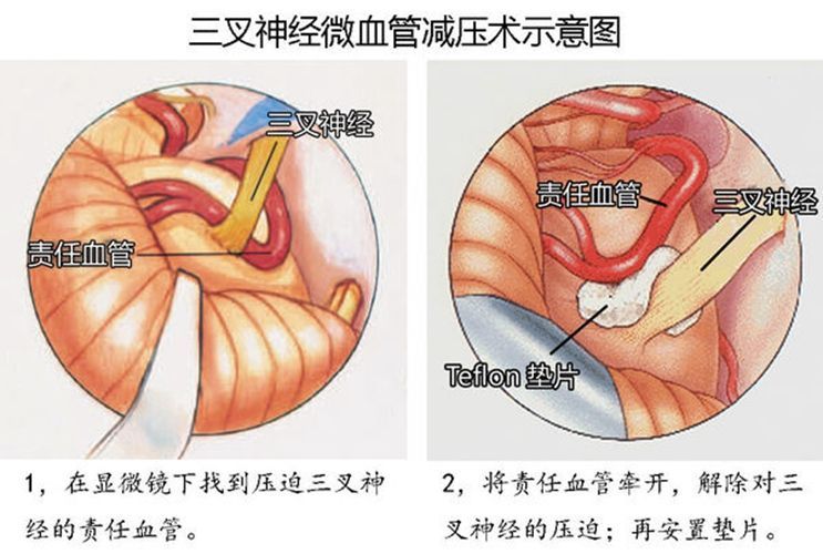 牙齿都拔光了牙龈会有什么变化,牙齿拔了几个了现在还痛怎么回事