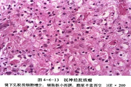 儿童胶质瘤最佳治疗方法,儿童胶质瘤的最佳治疗方法