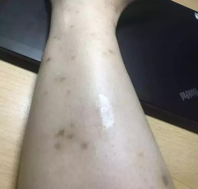 祛疤膏真的去不了增生吗,疤痕三四年了用祛疤膏能淡化吗