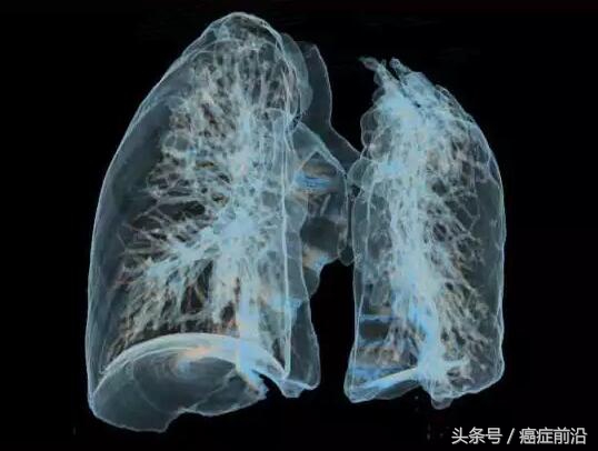 pd-1治疗小细胞肺癌有效吗,小细胞肺癌免疫治疗药物pd-1